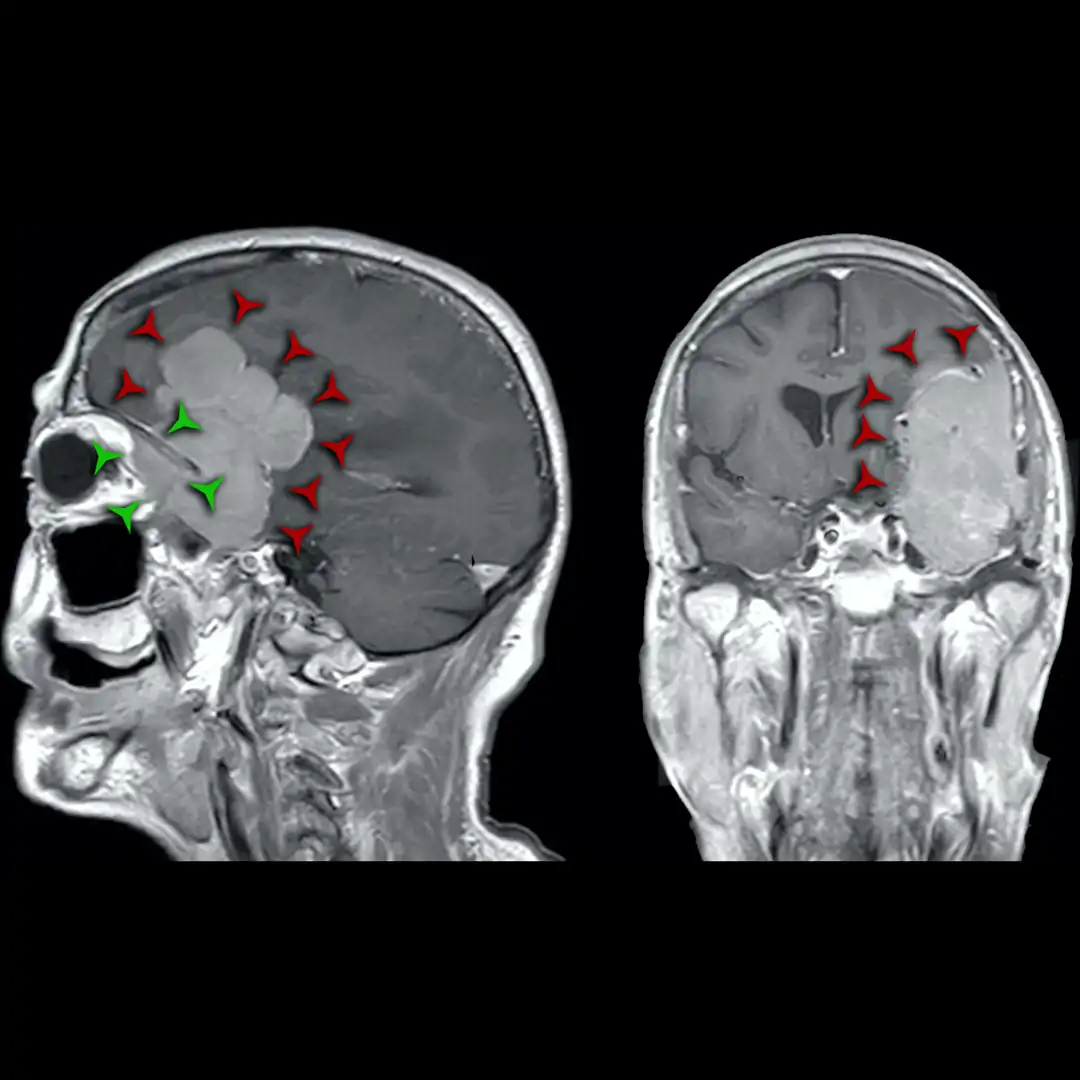 RM sequenza T1 con contrasto: meningioma sfenorbitario con fenomeno di invasione cono orbitario (indicatori verdi)