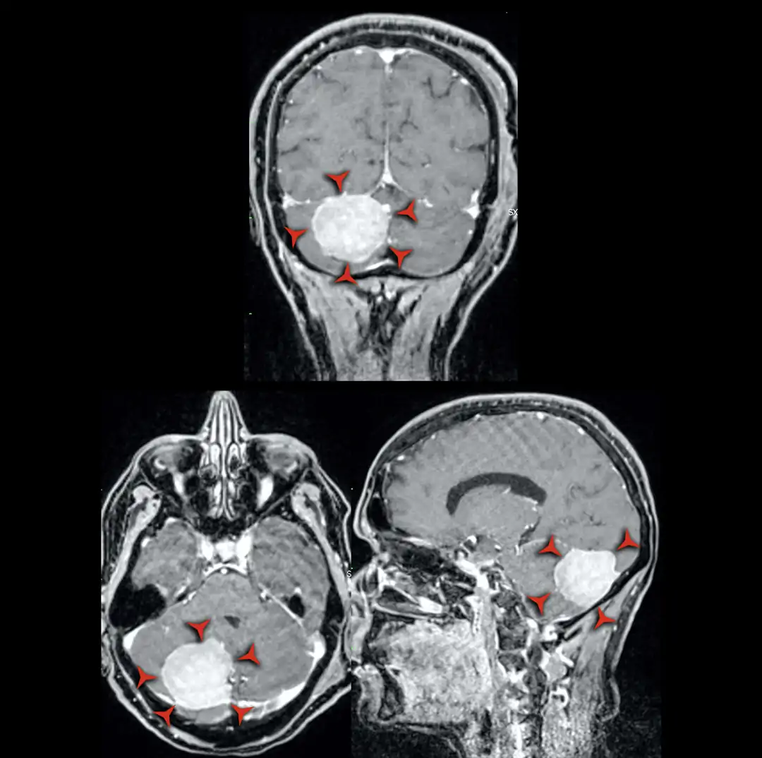 RM sequenza T1 con mezzo di contrasto- meningioma della fossa cranica posteriore