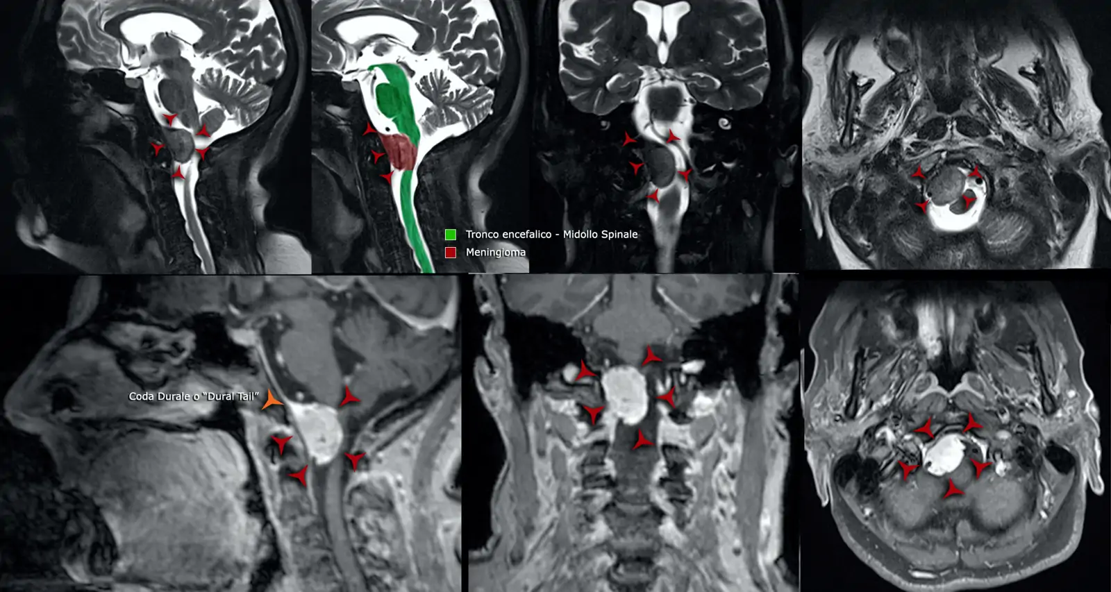 RM sequenze T2 (in alto) e T1 con contrasto (in basso)- meningioma della giunzione craniocervcale