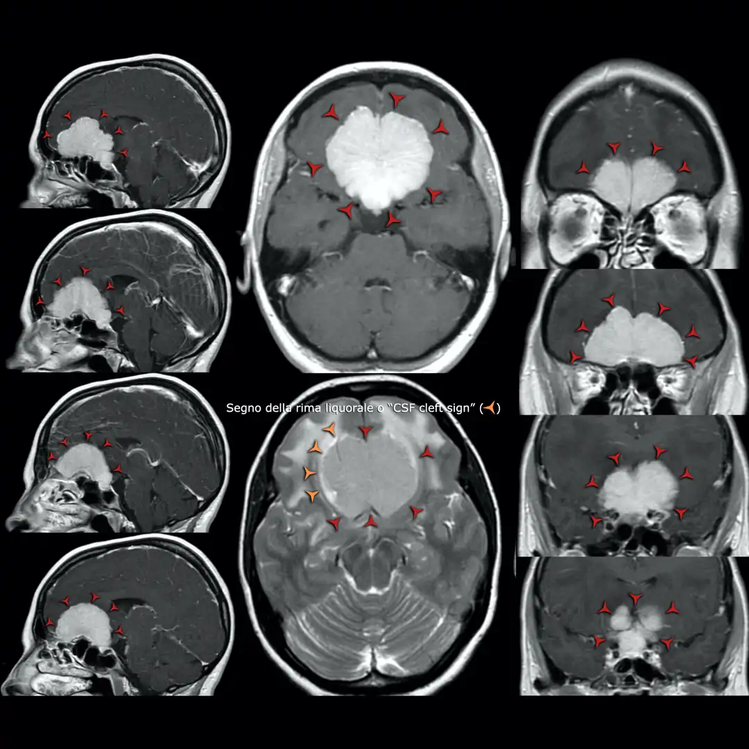 RM T1 con contrasto e T2 (in basso al centro) meningioma delle docce olfattorie
