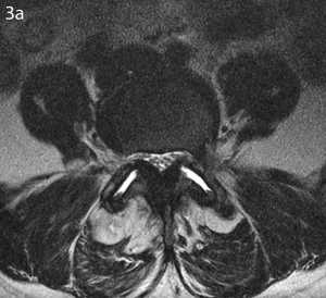 proiezione assiale di una risonanza magnetica lombare (sequenza T2) di un paziente che presenta grave degenerazione artrosica ed infiammazione dei complessi articolari posteriori della colonna a configurare quadro radiologico compatibile con una sindrome faccettale